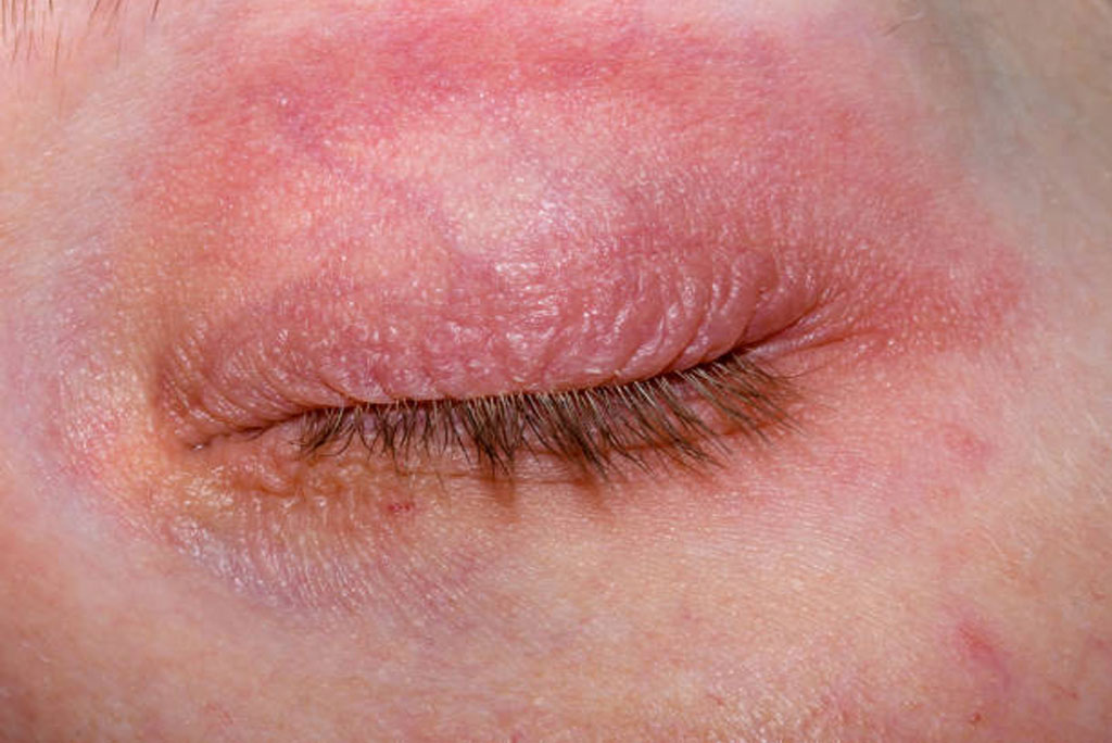 ट्रेकोमा एक संक्रामक आंखों की बीमारी है, जो क्लैमाइडिया ट्रैकोमैटिस नामक बैक्टीरिया से फैलती है। यह दुनिया में अंधेपन का सबसे बड़ा संक्रामक कारण माना जाता है। 