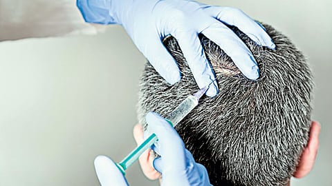 Platelet-Rich Plasma (PRP) treatment