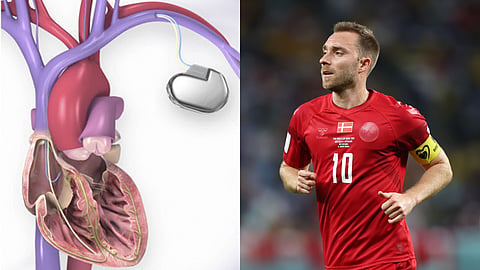 (L) Image of implantable cardioverter defibrillators used for representative purpose (R) Danish footballer Christian Eriksen