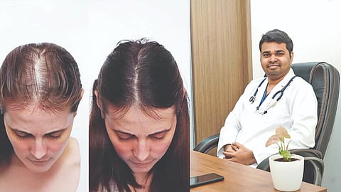Hair Transplant