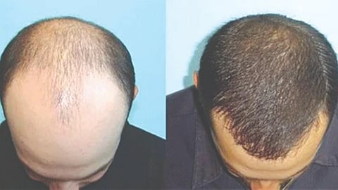 Social media, early hair loss drive young adults towards hair transplants; experts urge caution