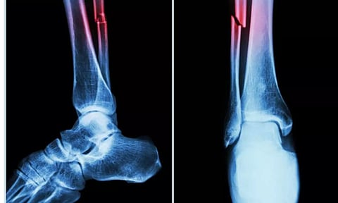 Covid-19 pandemic likely compromised bone health