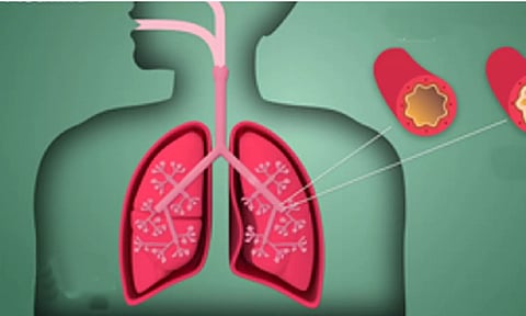 Representative image