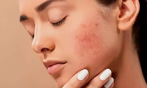 Representative image