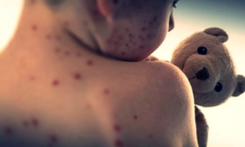 Measles alert in Sydney