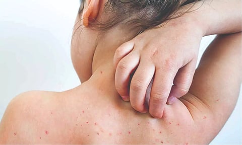 Representative image