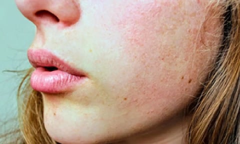 Representative image