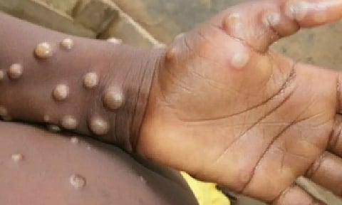 Representative Image&nbsp;