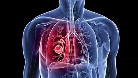 Representative Image of lung cancer&nbsp;