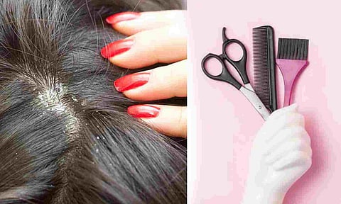 Dandruff or scalp psoriasis? Solve the mystery before buying a shampoo