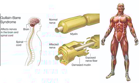 Guillain-Barre Syndrome