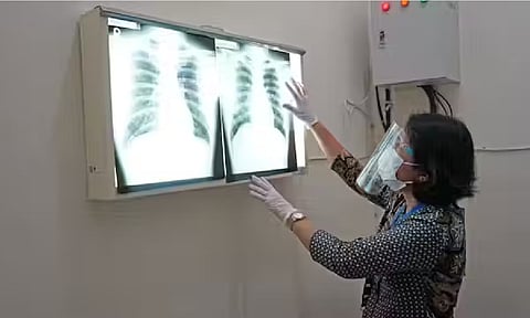 Why increasing rates of tuberculosis in UK, US should concern everyone