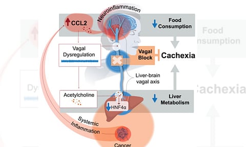 Increasing weight loss experienced by cancer patients (IANS)