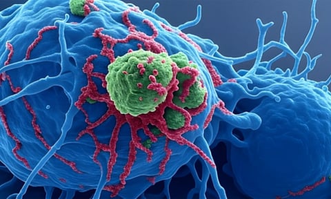 Cancer of the lining of the uterus (IANS)