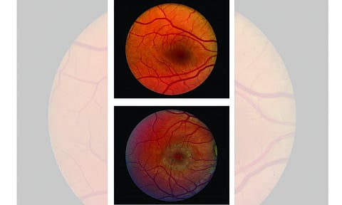 Vision loss caused by a blinding eye disease can be slowed with surgical implant (IANS)
