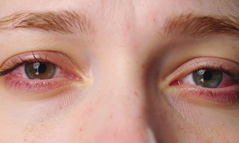 Digital eye strain (IANS)