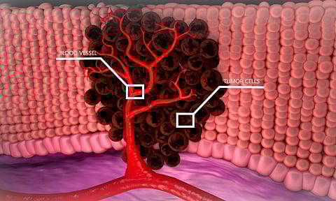 Representative Image of blood cancer&nbsp;