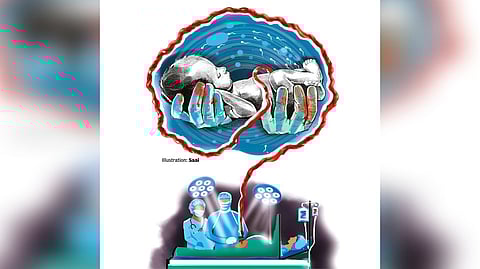 Rise in pre-term deliveries alarming, say experts