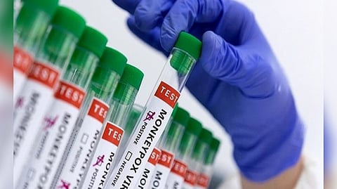 Monkeypox can become endemic