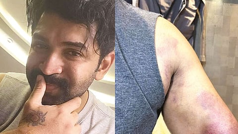 Arun Vijay met with an injury and posted a picture of his bruises