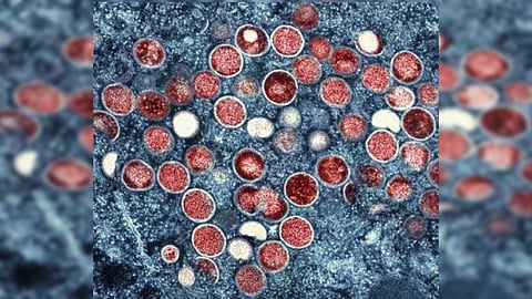NIAID shows a colorized transmission electron micrograph of monkeypox particles (red) found within an infected cell (blue)