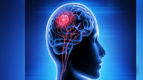 Representative image