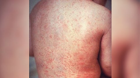 Representative Image