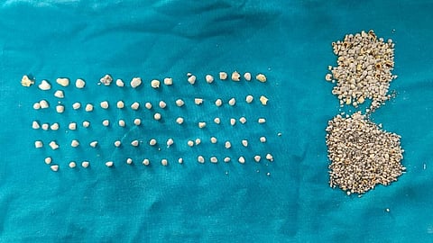 The removed gallbladder stones