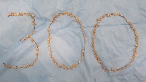 The clearance of the stone burden of more than 7cms was carried through a key-hole incision of merely 5mm in size