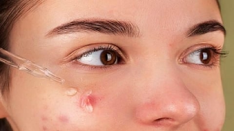 Representative image