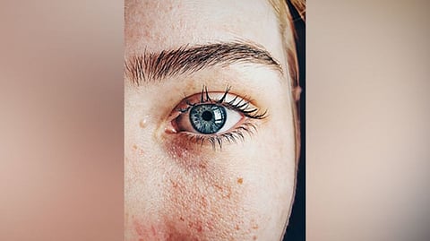 Representative Image