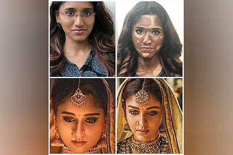 Makeup artist paints skin to resemble person with vitiligo for an experiment