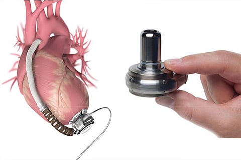 Pak girl gets world’s smallest heart pump implant in city hosp
