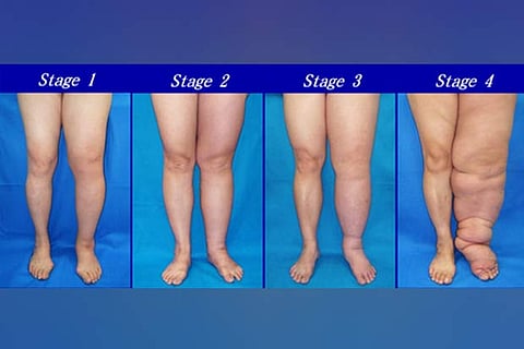 Physical exercises can help cure Lymphedema