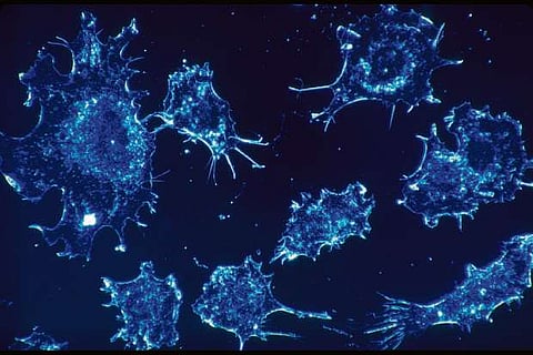 Cancer patients at doubled risk of dying from stroke: Study