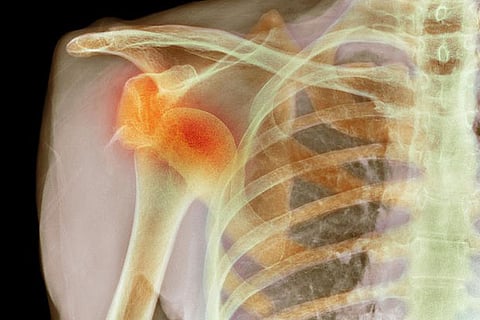 Physiotherapy can treat shoulder dislocation