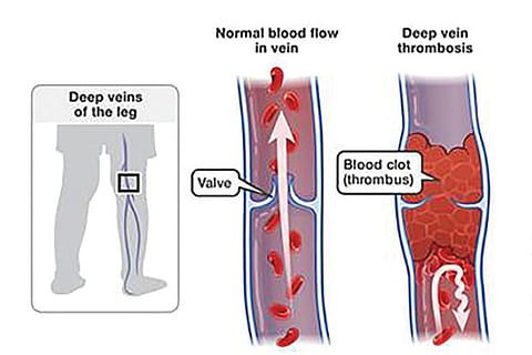 Deep vein thrombosis can cause death