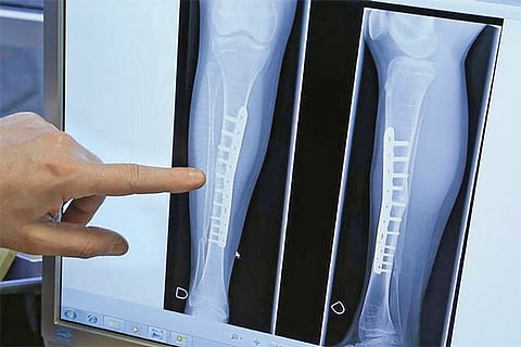 Osteoporosis: Cure at hand for silent killer