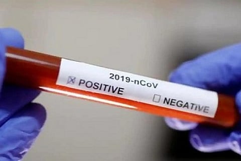 COVID-19: Andhra cases 572, to deploy 1 lakh rapid test kits