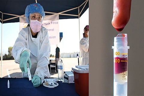 A rapid coronavirus antibody test; Blood sample for an IgG antibody test