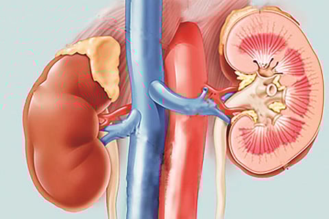 Mediterranean diet may help kidney patients post transplant
