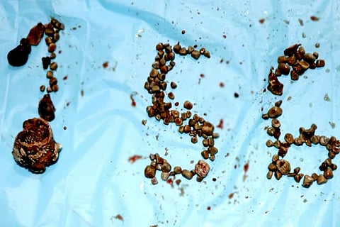 156 kidney stones extracted from a man