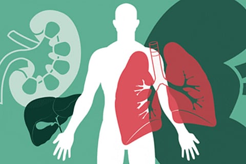 COVID-19 mortality high in kidney transplant recipients, say experts