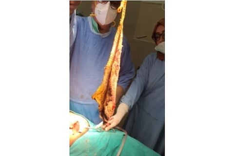 Surgical sponge (Source: IANS)