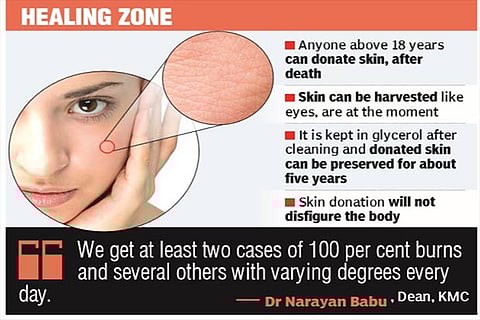 Kilpauk Med College Hospital famous for burns care, to get skin bank