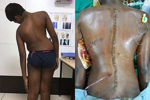 Picture of Raj Devnath, before (L) and after (R) the long surgery on his curved spine