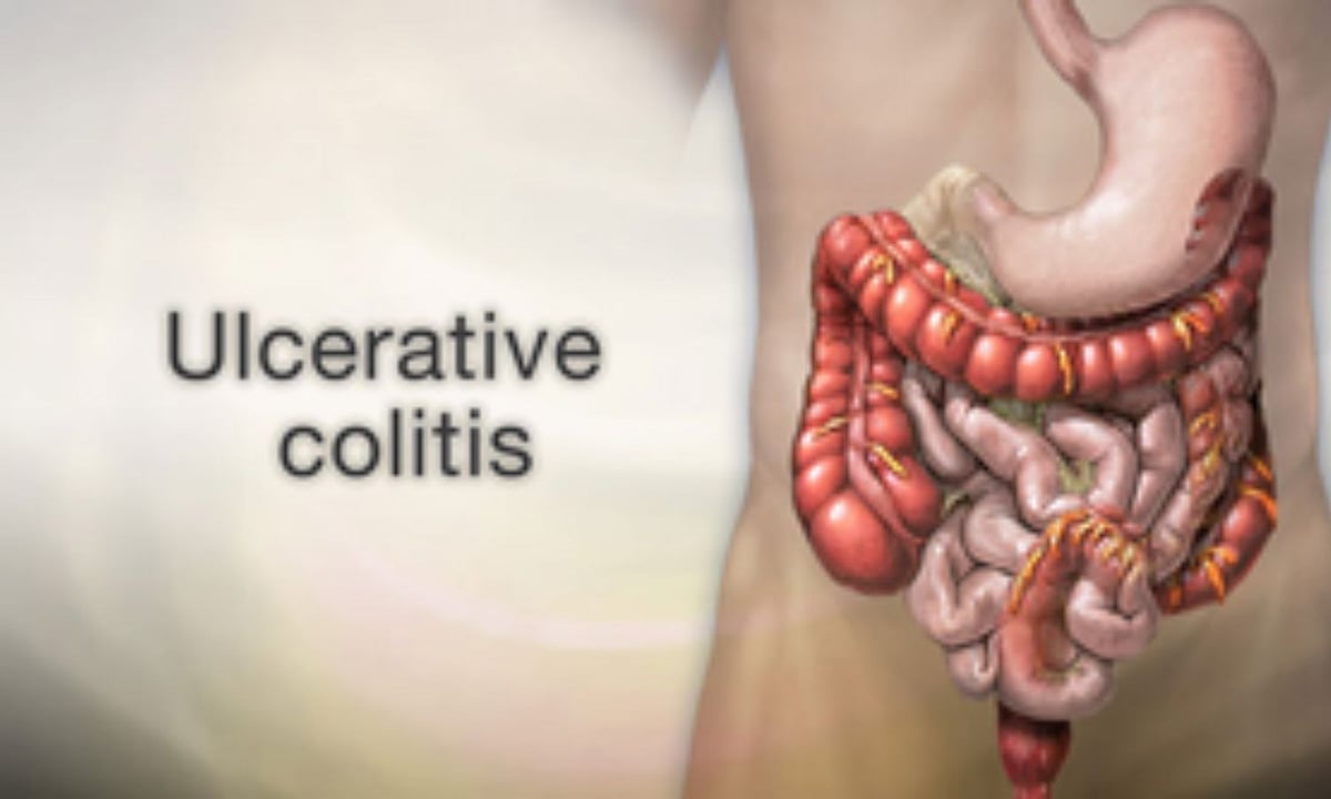 Scientists link colon cancer risk to specific gene in ulcerative colitis