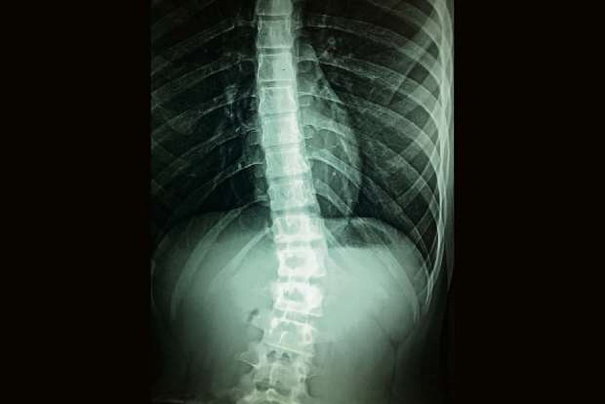 Pateints Trunk This robotic trunk to aid patients with spinal cord injury