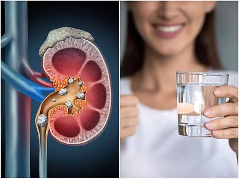 Kidney Stones: দিনে কতটা জল খেলে কিডনি স্টোন আপনা থেকেই বেরিয়ে যায়?  জানালেন চিকিৎসক - how to pass kidney stones with drinking water know from  doctor rudrajit pal - eisamay