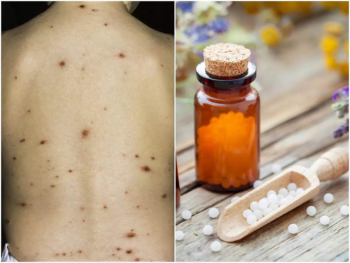 Chicken Pox Homeopathy: হোমিওপ্যাথি ওষুধেই আটকে যাবে ভয়ংকর চিকেন পক্স ...
